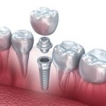 implant dentar