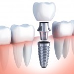 Care sunt avantajele unui implant dentar?