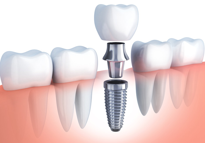 Care sunt avantajele unui implant dentar?